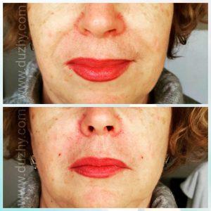 Botox Nasolabial Folds Before And After Photos (4)