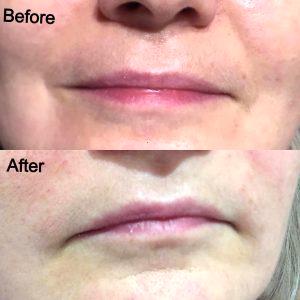 Botox Nasolabial Folds Before And After Photos (5)