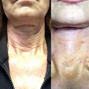 Botox Neck Treatment Pre And Post (1)