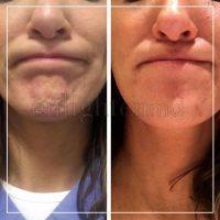 Botox Of Chin Before And After