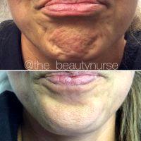 Botox On Chin Dimples Photos