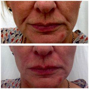 Botox On Marionette Lines Photos (2)