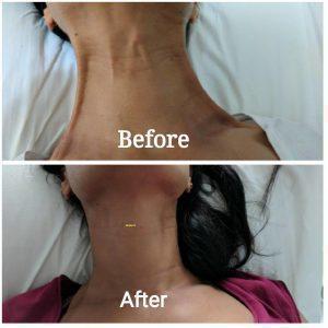 Botox On Neck Before And After (1)