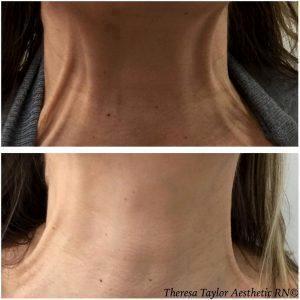 Botox On Neck Before And After (2)
