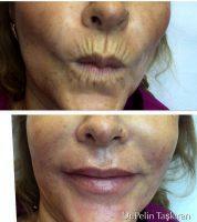 Botox On Smokers Lines Before And After Photos (10)