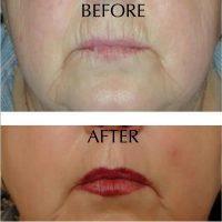 Botox On Smokers Lines Before And After Photos (11)