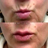 Botox On Smokers Lines Before And After Photos (14)
