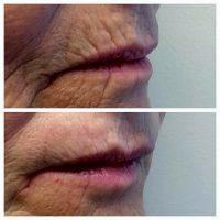Botox On Smokers Lines Before And After Photos (16)