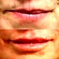 Botox On Smokers Lines Before And After Photos (18)
