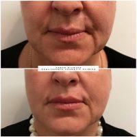 Botox On Smokers Lines Before And After Photos (19)