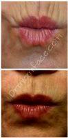 Botox On Smokers Lines Before And After Photos (2)