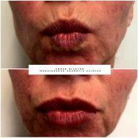 Botox On Smokers Lines Before And After Photos (20)