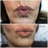 Botox On Smokers Lines Before And After Photos (21)
