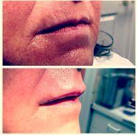 Botox On Smokers Lines Before And After Photos (3)
