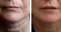 Botox On Smokers Lines Before And After Photos (4)