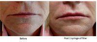 Botox On Smokers Lines Before And After Photos (5)