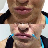 Botox On Smokers Lines Before And After Photos (6)