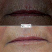 Botox On Smokers Lines Before And After Photos (7)