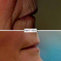 Botox On Smokers Lines Before And After Photos (9)