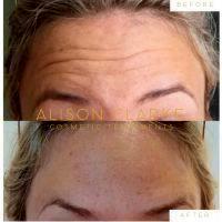 Botox Or Filler Injectables For Forehead Wrinkles
