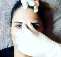 Botox Or Juvederm Filler For Forehead