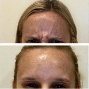 Botox Prevention Of Wrinkles