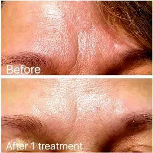 Botox Prevention Of Wrinkles After 1 Treatment
