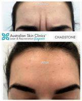 Botox Relaxes The Group Of Muscles Between The Brows