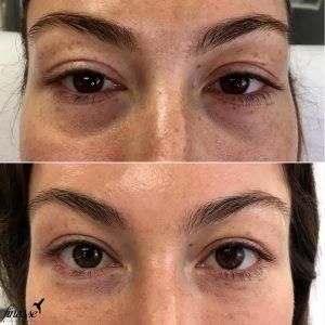 Botox Remove Bags Under Eyes
