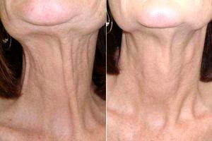 Botox Results By Doctor Julie Khanna, MD, FRCSC, Ontario Plastic Surgeon