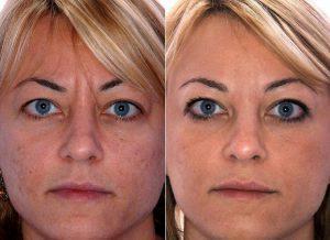 Botox Results By Dr. Susan M. Hughes, MD, FACS, Cherry Hill Oculoplastic Surgeon
