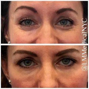 Botox Technique Crows Feet Pre And Post