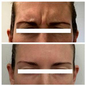 Botox To Forehead, Between Eyebrows (galbellar Lines), And Crow's Feet By Dr. Dudas,San Francisco