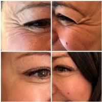 Botox To Help Crows Feet