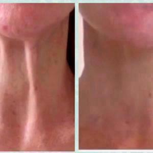 Botox To Relax Neck Muscles