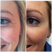 Botox To Remove Crow's Feet Before And After