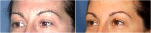 Botox To The Corrugator Muscles Under Eyebrows And Restylane Under Wrinkles By Dr. David Mabrie, San Francisco