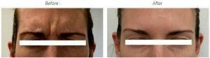 Botox To The Crow's Feet, Frown Lines, And The Forehead By Dr. Jason Dudas,San Francisco