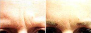 Botox To The Glabella To Minimize The Frown Lines By Anita Mandal, M.D., Doctor In Palm Beach Gardens, Florida