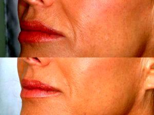 Botox To The Nasolabial Folds At Gateway Aesthetic Institute And Laser Center,Salt Lake City