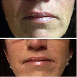 Botox To Treat Marionette Lines Before And After (2)