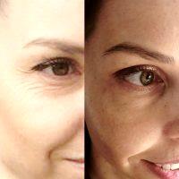 Botox Top Up Crow's Feet Before And After