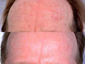 Botox Treatment At Gateway Aesthetic Institute And Laser Center,Salt Lake City