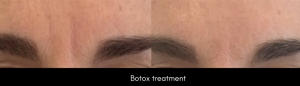 Botox Treatment By Dr. Evans,San Francisco