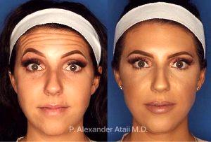 Botox Treatment By Dr. P. Alexander Ataii, M.D., Dermatologist In San Diego, California