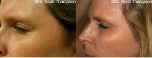Botox Treatment By Dr. Scott K. Thompson,Salt Lake City