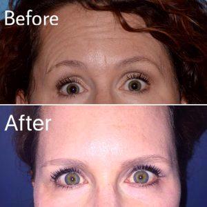 Botox Treatment Done By Expert Nurse Injector, Beth Sheiner,Salt Lake City