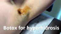 Botox Treatment For Hyperhidrosis Has Also Been Scientifically Proven