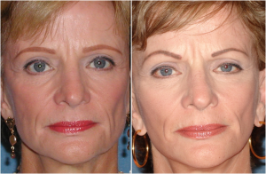 Botox Treatments By Dr. Justo