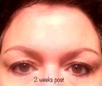 Botox Type A 2 Weeks Post With Dr. Utah Facial Plastics, Salt Lake City Plastic Surgeon